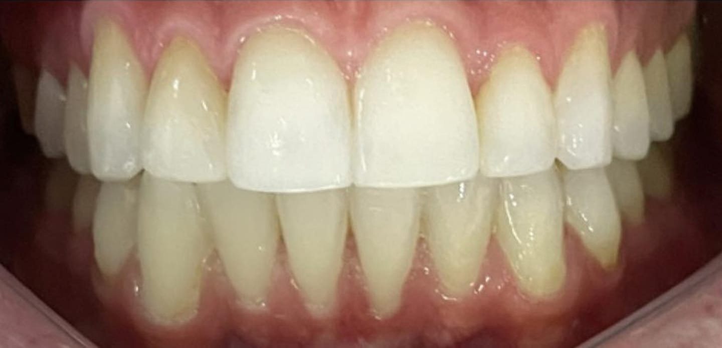 2depois–invisalign 2depois--invisalign