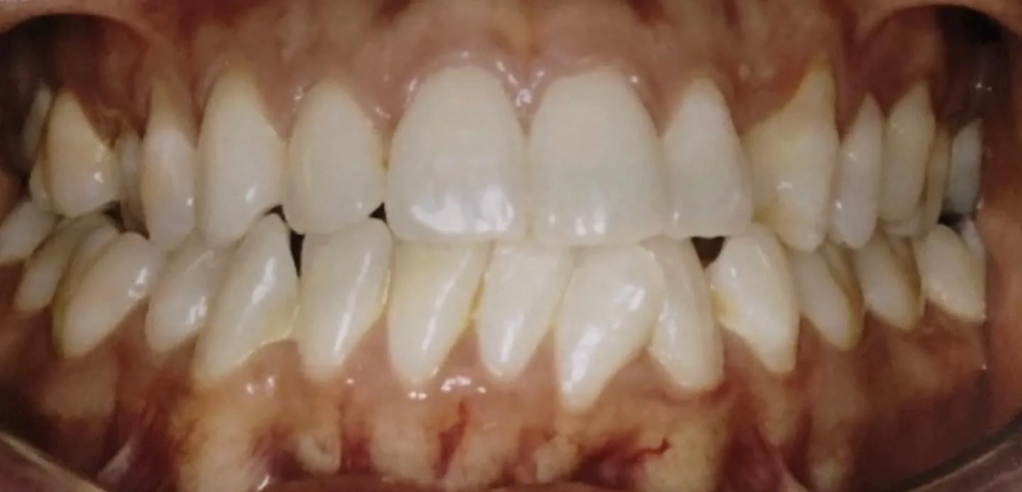 3antes–invisalign 3antes--invisalign