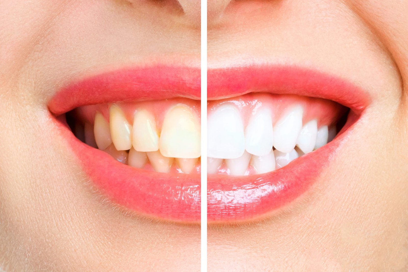 dentes-da-mulher-antes-e-depois-clareamento-imagem-simboliza-estomatologia (1)