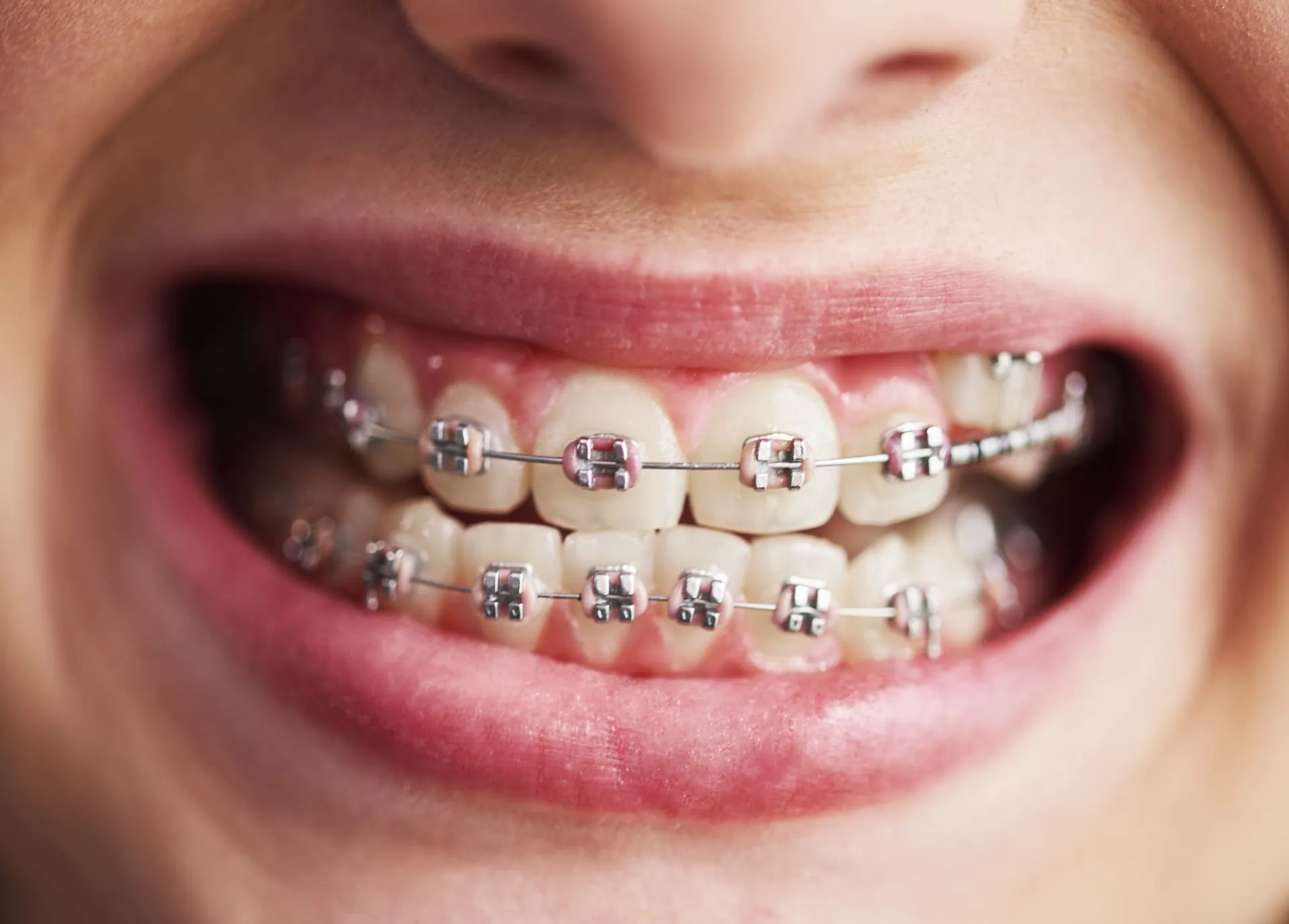 foto-de-dentes-de-crianca-com-aparelho (1)