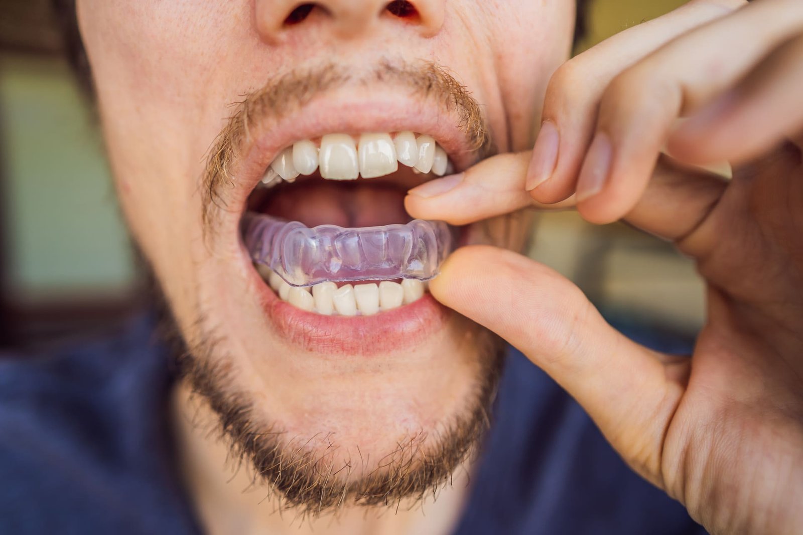 homem-colocando-uma-placa-de-mordida-na-boca-para-proteger-os-dentes-a-noite-ranger-causado-pelo-bruxismo-visao-de-perto-de-sua-mao-e-aparelho (1)