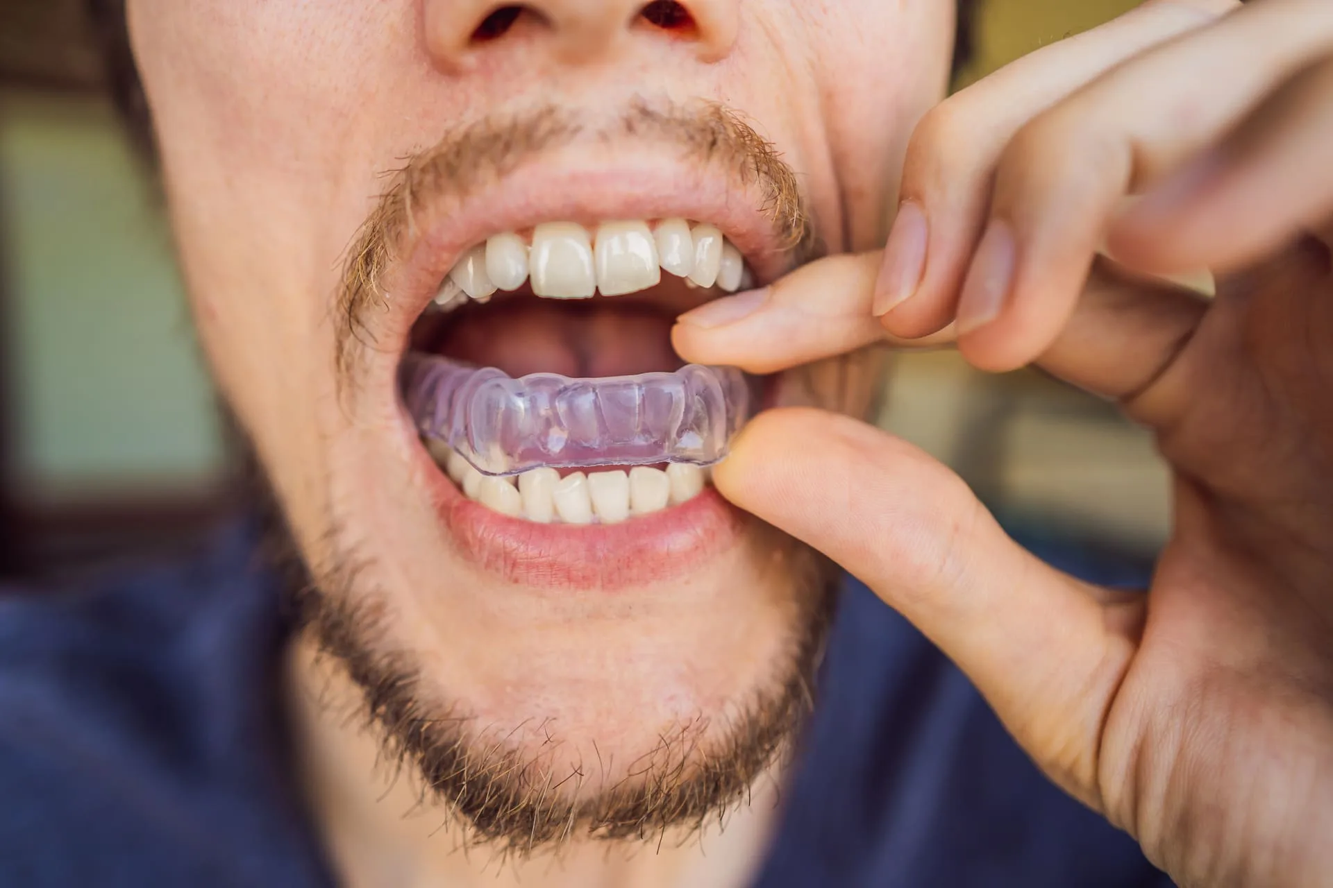 homem-colocando-uma-placa-de-mordida-na-boca-para-proteger-os-dentes-a-noite-ranger-causado-pelo-bruxismo-visao-de-perto-de-sua-mao-e-aparelho (1)