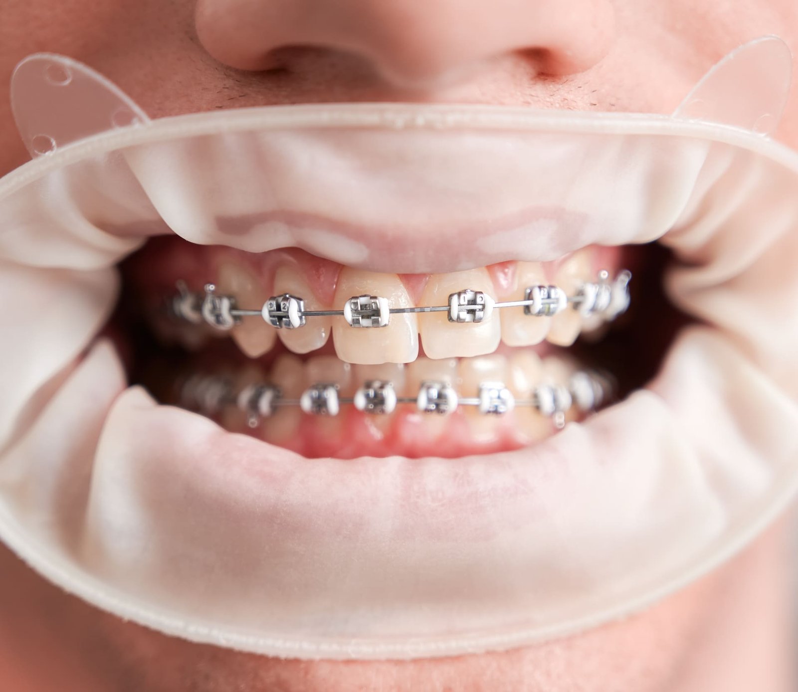 paciente-sexo-masculino-com-ensecadeira-na-boca-mostrando-os-dentes-com-aparelho (1)